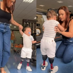 CRIANÇA AMPUTADA DÁ PRIMEIROS PASSOS COM PRÓTESES APÓS HISTORIA QUE COMOVEU O PAÍS